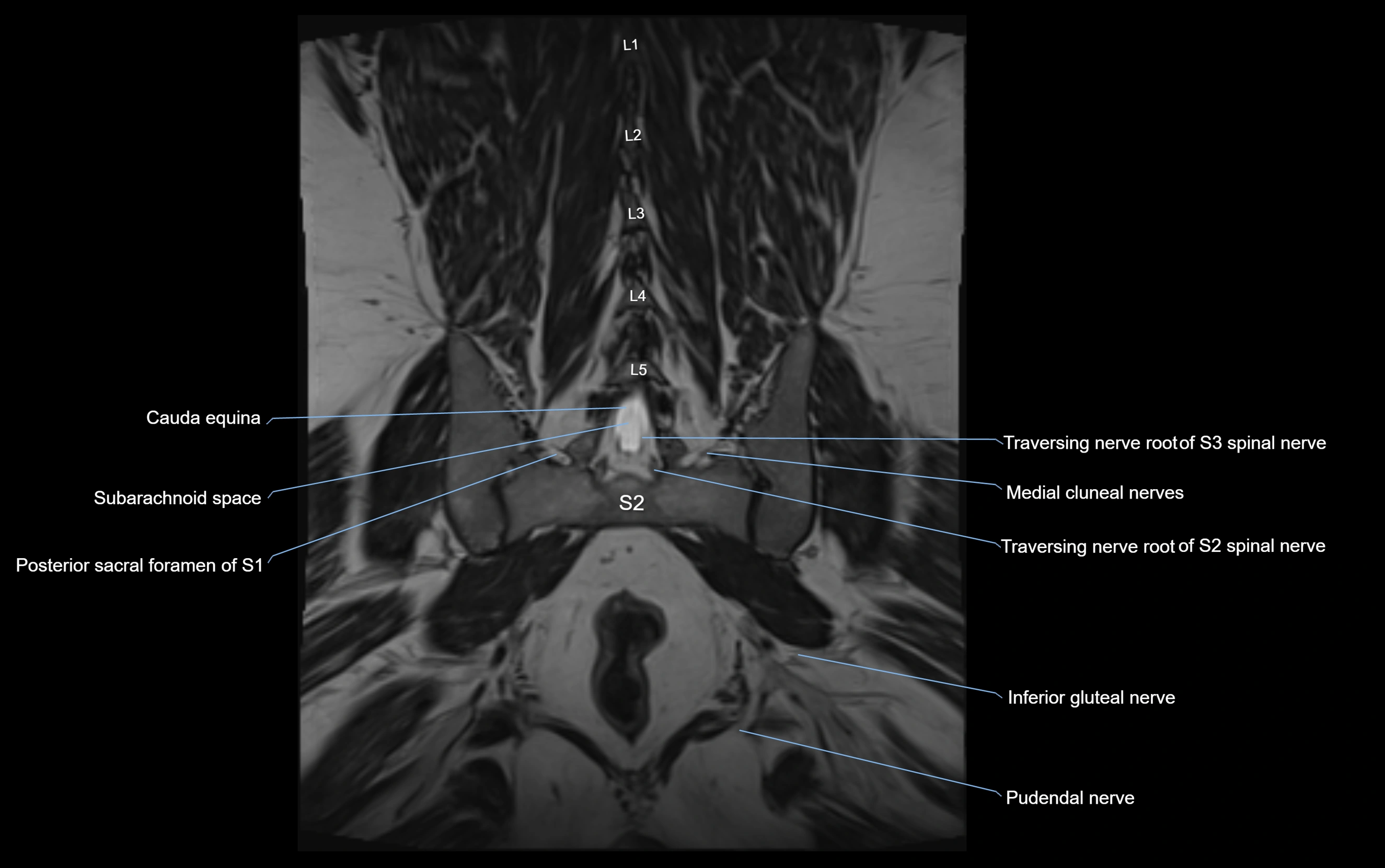 MR lumbosacral plexus cross sectional anatomy 3T  radiology  image-img-09001-00058.webp